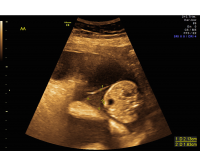 Twin-Twin Transfusion Syndrome stuck twin